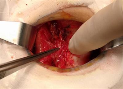 Surgical management of papillary thyroid carcinoma coexisting with Hashimoto’s disease: a single-center retrospective cohort study